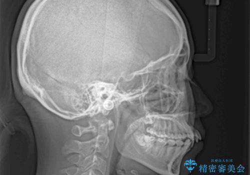 【モニター】横顔のシルエットをスッキリと ワイヤー装置による抜歯矯正治療の治療前