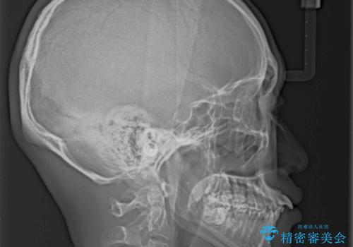 出っ歯と八重歯 目立たない裏側装置でスッキリとした口元にの治療前