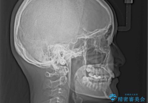 深い咬み合わせとデコボコの歯列をワイヤー矯正で改善の治療前