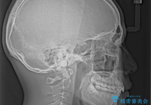 欠損した前歯とディープバイト ワイヤー矯正で短期間で治療の治療前