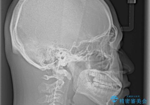 空隙歯列を閉じる 舌のトレーニングとワイヤー矯正の治療前