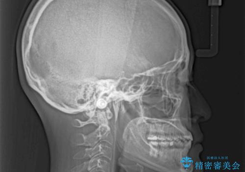 前歯のクロスバイトを治したい ワイヤー装置による矯正治療の治療後