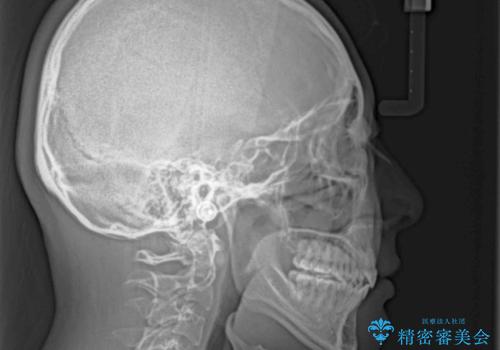 八重歯と乱れた咬み合わせを改善 ワイヤー装置での抜歯矯正の治療後