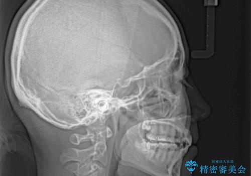 【モニター】横顔のシルエットをスッキリと ワイヤー装置による抜歯矯正治療の治療後