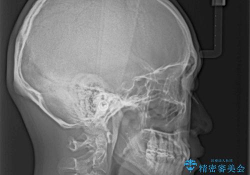 出っ歯と八重歯 目立たない裏側装置でスッキリとした口元にの治療後
