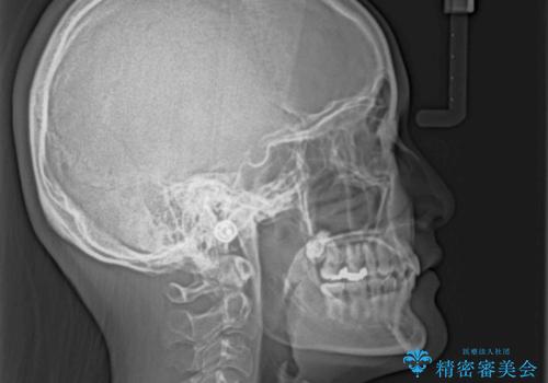 深い咬み合わせとデコボコの歯列をワイヤー矯正で改善の治療後