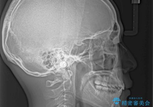 欠損した前歯とディープバイト ワイヤー矯正で短期間で治療の治療後