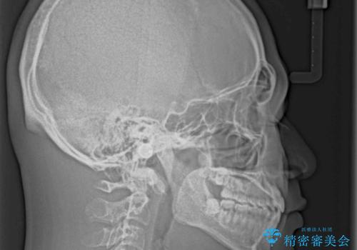 空隙歯列を閉じる 舌のトレーニングとワイヤー矯正の治療後