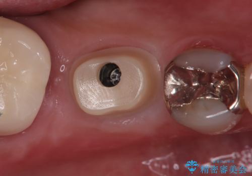 【インプラント】食事中に歯が割れた! かなり深いところまで歯が割れていたの治療中