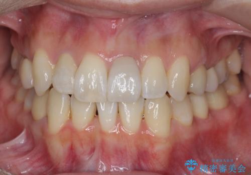 歯のがたつき　4本抜歯を回避してマウスピース矯正への症例 治療後