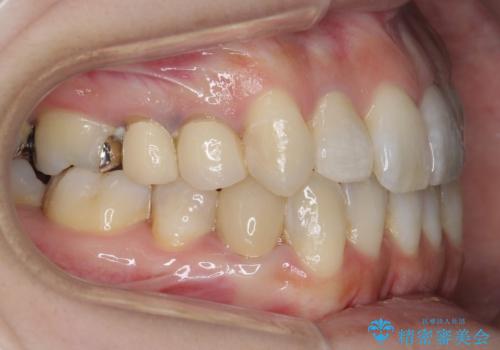 歯のがたつき　4本抜歯を回避してマウスピース矯正への治療後