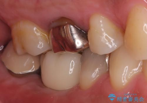 【インプラント】食事中に歯が割れた! かなり深いところまで歯が割れていたの治療後