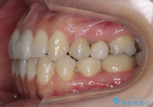 歯のがたつき　4本抜歯を回避してマウスピース矯正への治療後