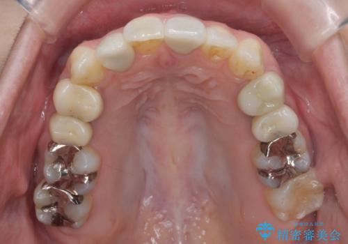 歯のがたつき 4本抜歯を回避してマウスピース矯正への治療後