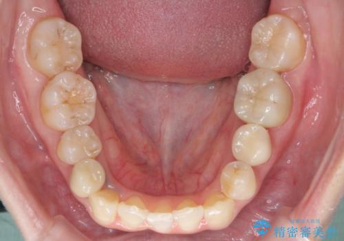 歯のがたつき 4本抜歯を回避してマウスピース矯正への治療後