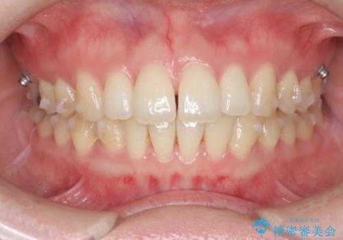 マウスピースで治す、出っ歯の矯正治療の治療中