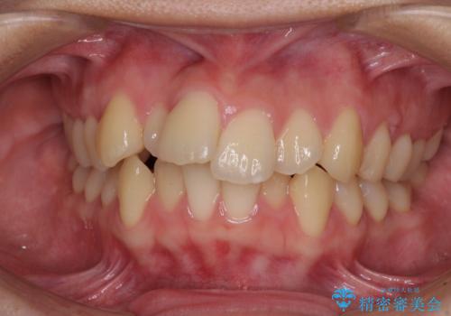 【モニター】横顔のシルエットをスッキリと ワイヤー装置による抜歯矯正治療の症例 治療前