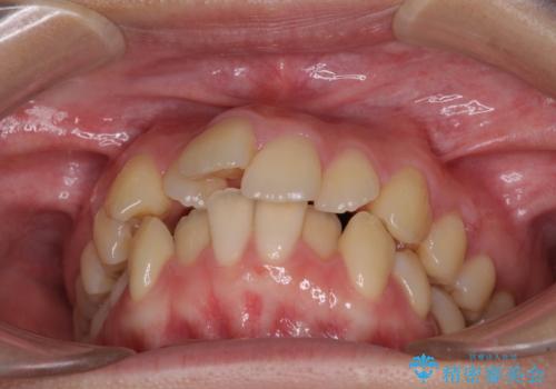 【モニター】横顔のシルエットをスッキリと ワイヤー装置による抜歯矯正治療の治療前