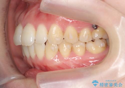 マウスピースで治す、出っ歯の矯正治療の治療中