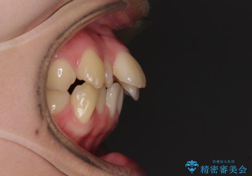 【モニター】横顔のシルエットをスッキリと ワイヤー装置による抜歯矯正治療の治療前