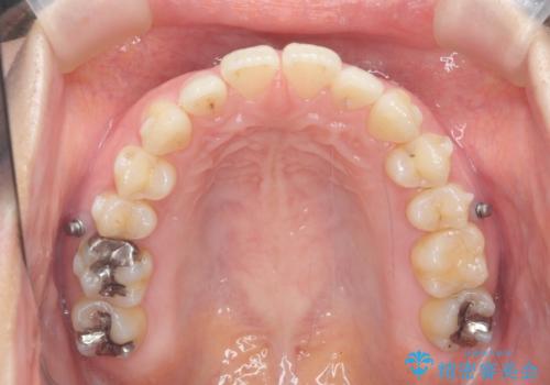 マウスピースで治す、出っ歯の矯正治療の治療中