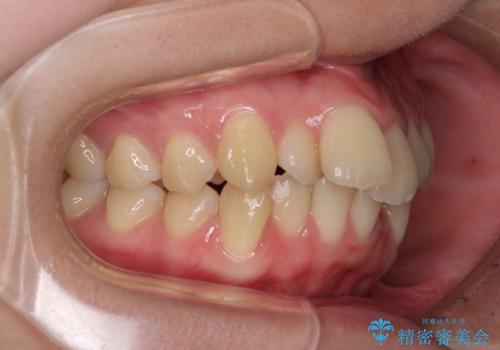 【モニター】横顔のシルエットをスッキリと ワイヤー装置による抜歯矯正治療の治療前