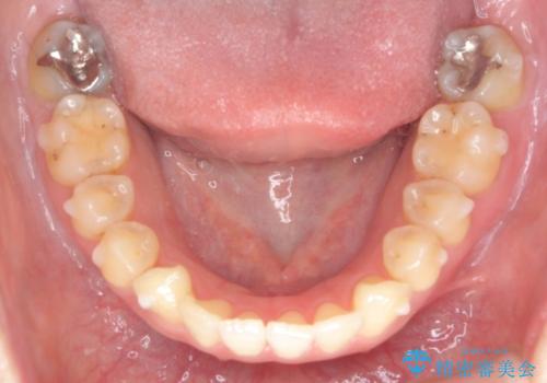 マウスピースで治す、出っ歯の矯正治療の治療中