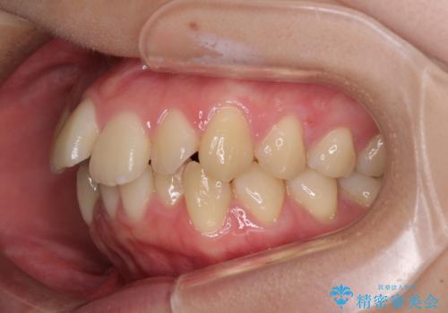 【モニター】横顔のシルエットをスッキリと ワイヤー装置による抜歯矯正治療の治療前