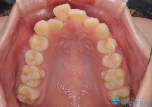 【モニター】横顔のシルエットをスッキリと ワイヤー装置による抜歯矯正治療の治療前
