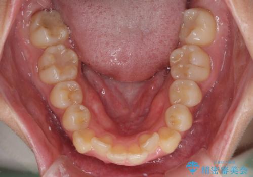 【モニター】横顔のシルエットをスッキリと ワイヤー装置による抜歯矯正治療の治療前