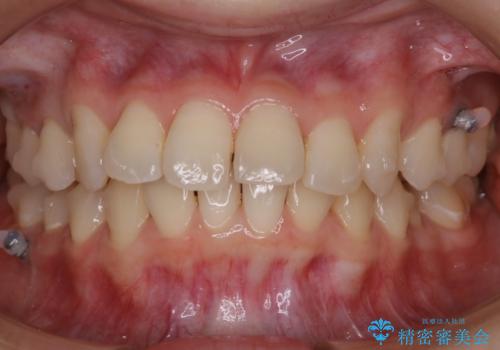 【非抜歯】結婚式に向けて矯正で素敵な笑顔を!の治療中