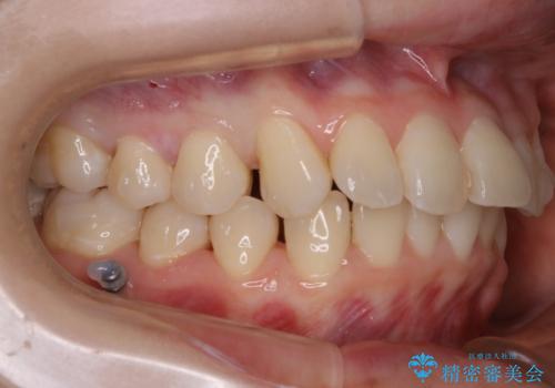 【非抜歯】結婚式に向けて矯正で素敵な笑顔を!の治療中