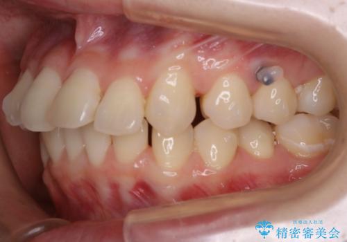 【非抜歯】結婚式に向けて矯正で素敵な笑顔を!の治療中