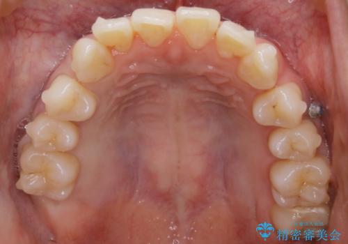 【非抜歯】結婚式に向けて矯正で素敵な笑顔を!の治療中