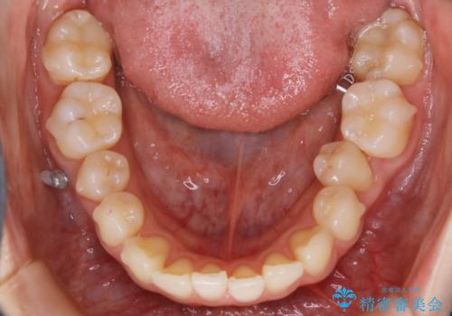 【非抜歯】結婚式に向けて矯正で素敵な笑顔を!の治療中