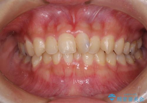 深い咬み合わせとデコボコの歯列をワイヤー矯正で改善の症例 治療前