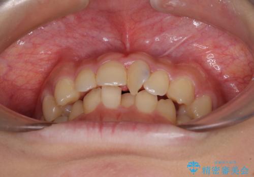 深い咬み合わせとデコボコの歯列をワイヤー矯正で改善の治療前