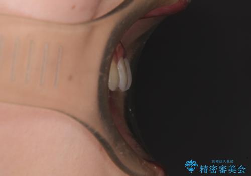 深い咬み合わせとデコボコの歯列をワイヤー矯正で改善の治療前