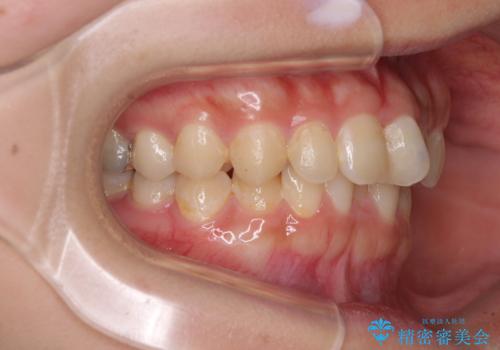 深い咬み合わせとデコボコの歯列をワイヤー矯正で改善の治療前