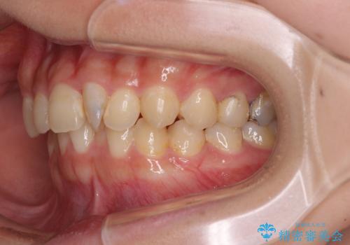 深い咬み合わせとデコボコの歯列をワイヤー矯正で改善の治療前
