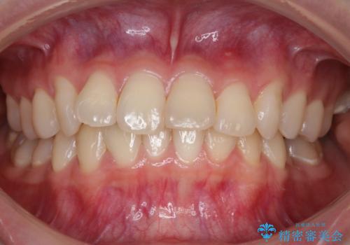 【非抜歯】結婚式に向けて矯正で素敵な笑顔を!の治療前