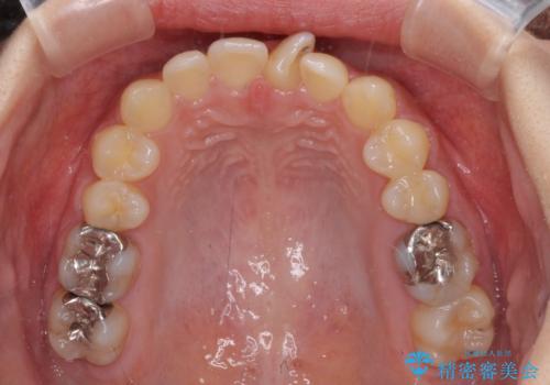 深い咬み合わせとデコボコの歯列をワイヤー矯正で改善の治療前