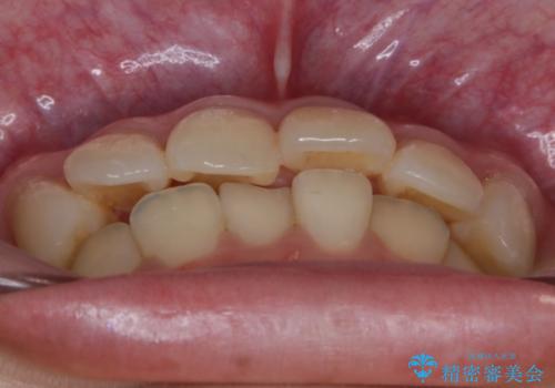 【非抜歯】結婚式に向けて矯正で素敵な笑顔を!の治療前