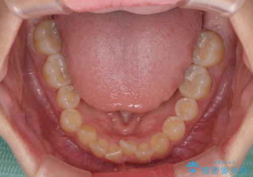 深い咬み合わせとデコボコの歯列をワイヤー矯正で改善の治療前