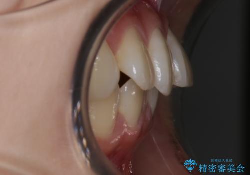 【非抜歯】結婚式に向けて矯正で素敵な笑顔を!の治療前