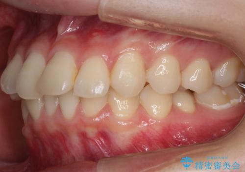 【非抜歯】結婚式に向けて矯正で素敵な笑顔を!の治療前