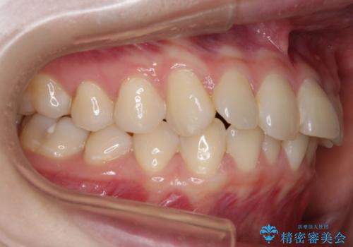 【非抜歯】結婚式に向けて矯正で素敵な笑顔を!の治療前