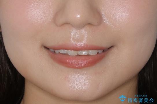 【非抜歯】結婚式に向けて矯正で素敵な笑顔を!の治療前(顔貌)