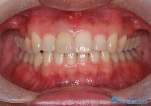 2級ディープバイト 遠心移動を伴うマウスピース矯正の治療後