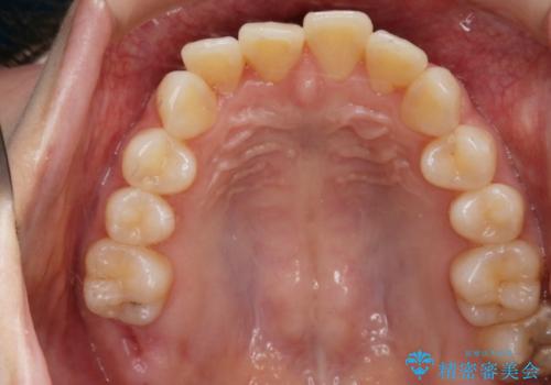 【非抜歯】結婚式に向けて矯正で素敵な笑顔を!の治療前